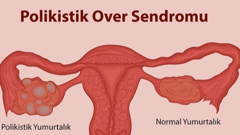 Polikistik Over Sendromu